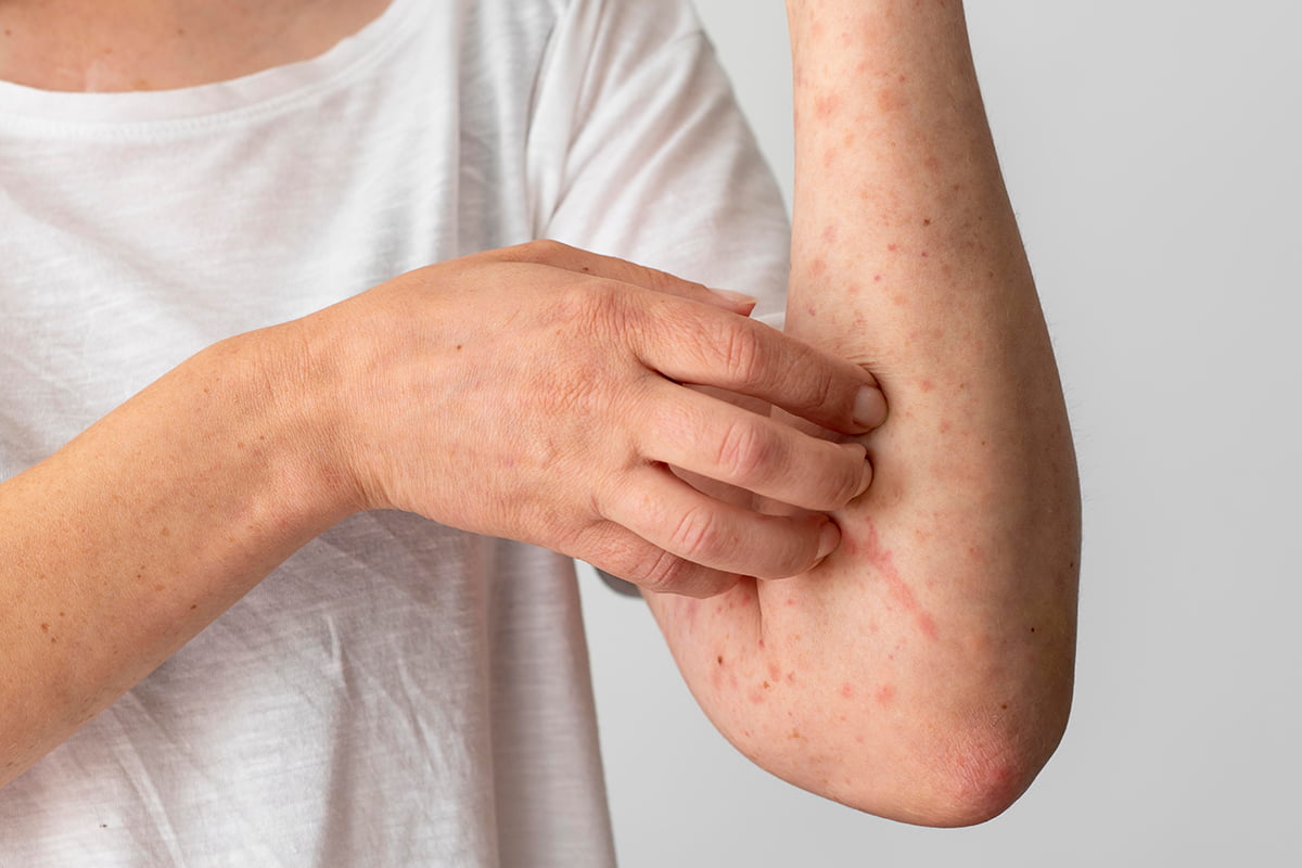 Dermatitis Causas, Síntomas y Tratamientos Efectivos