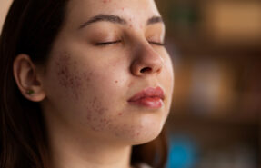 Descubre Como Combatir el Acne en la Piel 287x185 - Dermat&oacute;logos Online