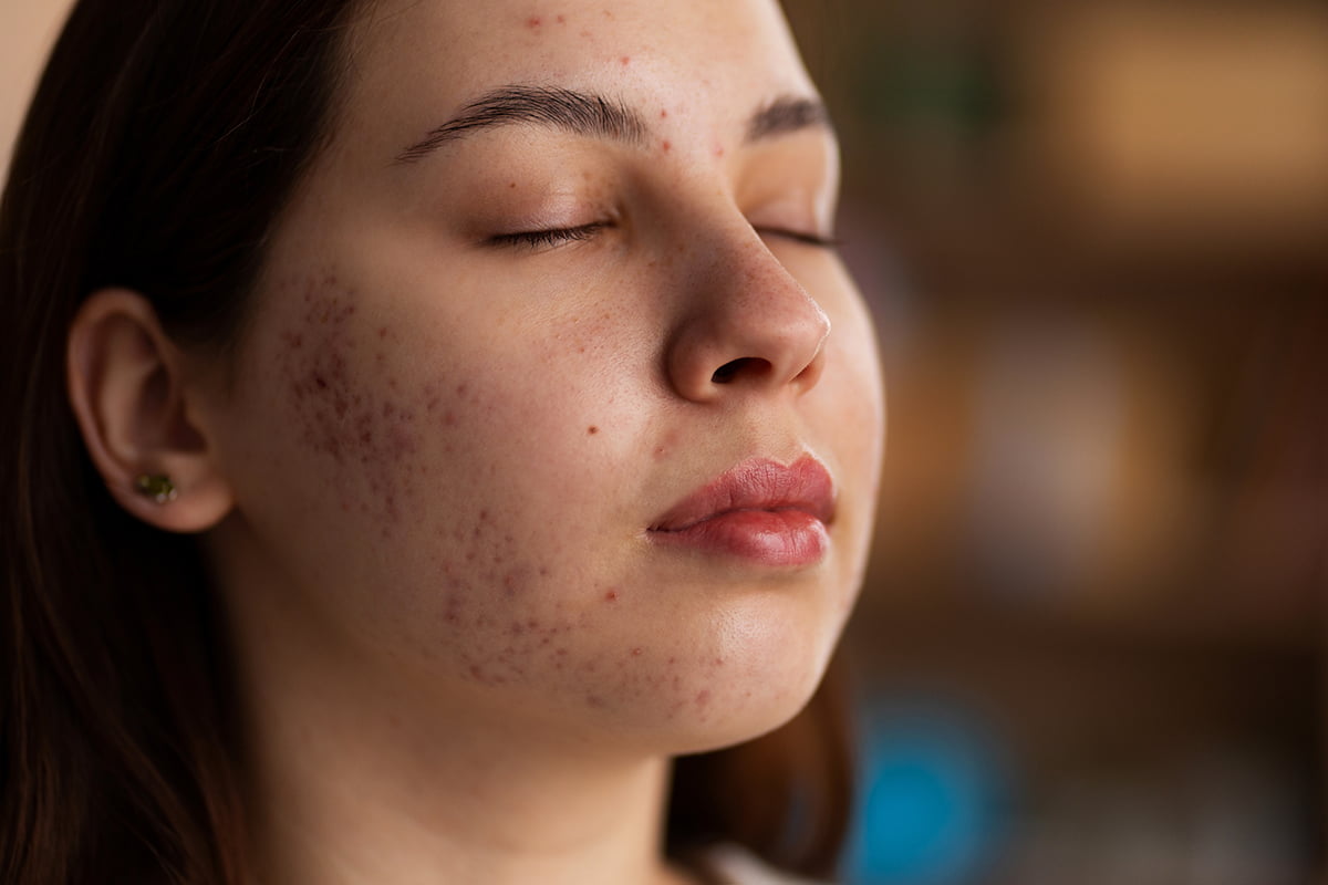 Descubre Como Combatir el Acne en la Piel - Descubre Cómo Combatir el Acné en la Piel