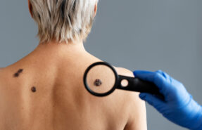 Descubre Como Eliminar Verrugas de Forma Efectiva 287x185 - Dermat&oacute;logos Online