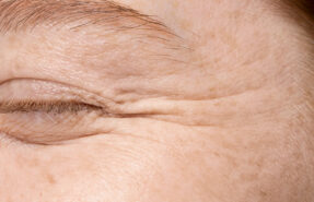arrugas 287x185 - Dermat&oacute;logos Online