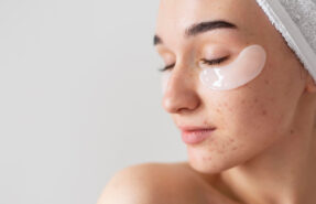 Consulta Dermatologica La Solucion para Diversos Problemas de la Piel 287x185 - Dermat&oacute;logos Online